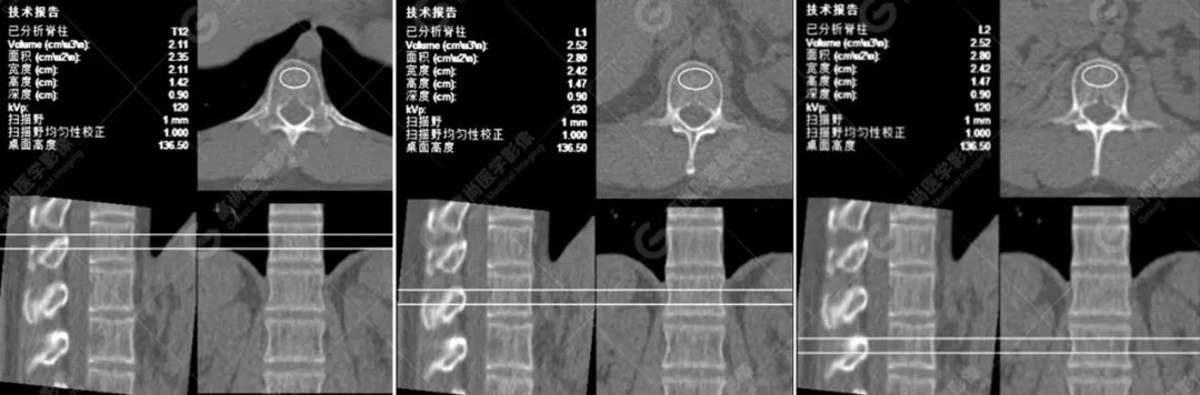 骨密度达到这个数，提醒你要补补钙了？专家为你解答