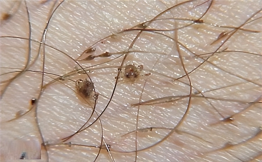 生存了上亿年的虱子,曾经吸过恐龙血,为什么现在基本看不到了?