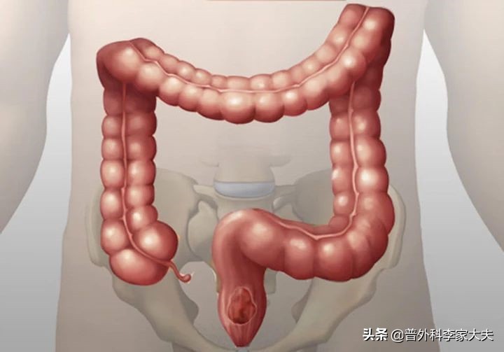 T3N1M0期直肠癌患者术后做放疗27次化疗5次，不想再做，行吗？