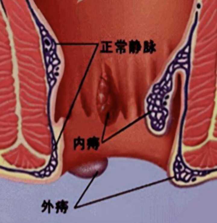 不同的痔疮都是怎么治疗的呢？