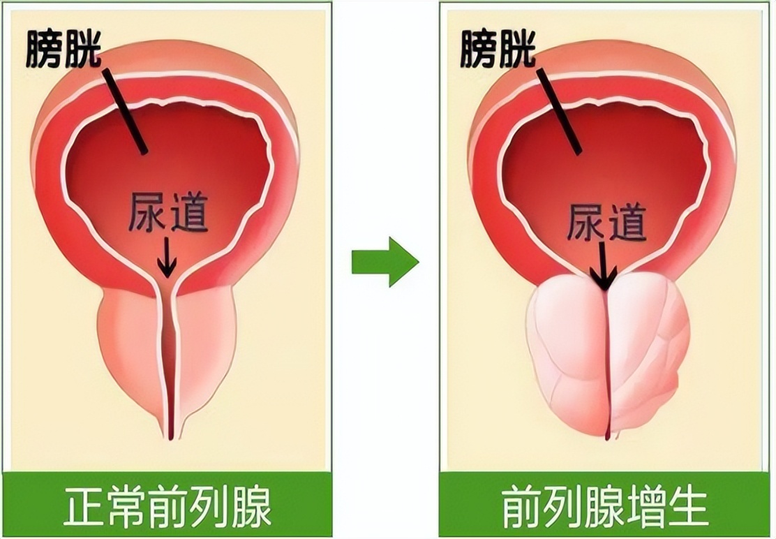 前列腺是