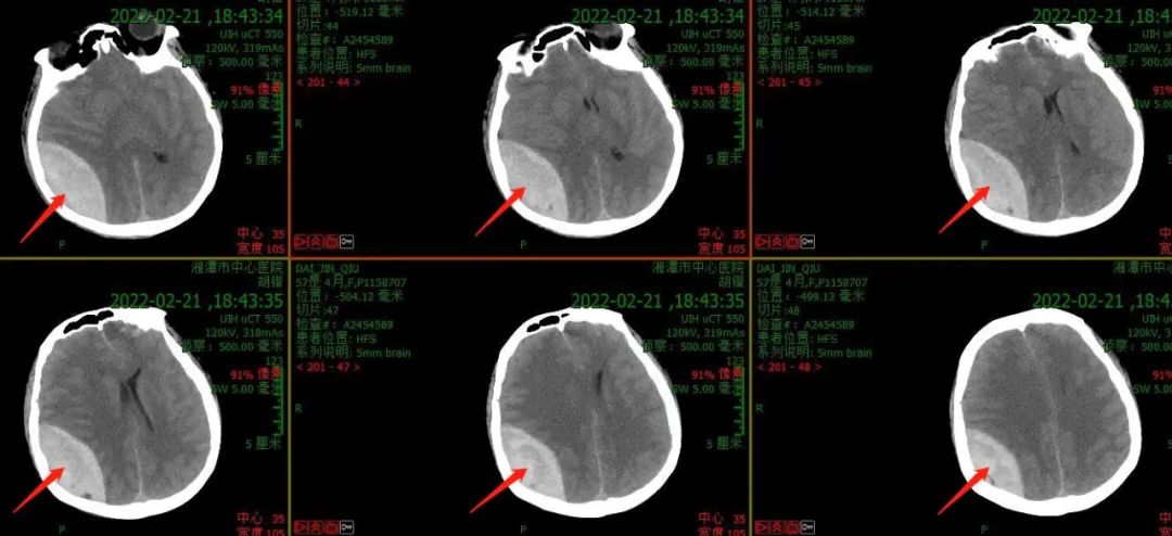 新闻报道中被车撞了不肯就医的重型脑外伤患者，今天出院了