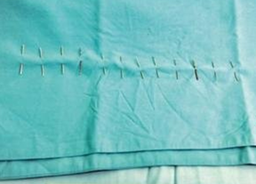 2014年，山东女婴体内“长”16根钢针，得知报警后舅妈服药自杀