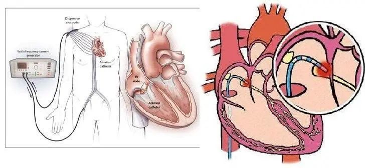 消融导管提交CE！磁导航心脏消融机器人