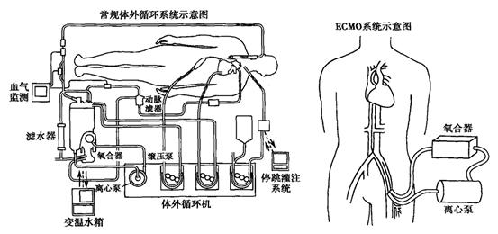 ICU終極武器！國產(chǎn)ECMO終于來了