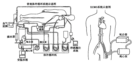 ICU终极武器！国产ECMO终于来了