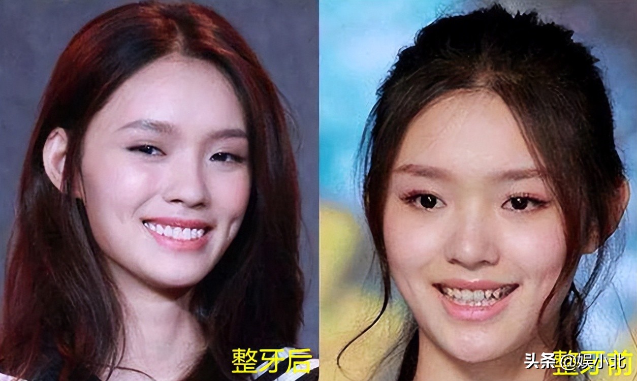 说刘亦菲牙齿丑的，是烤瓷牙看多了吧？