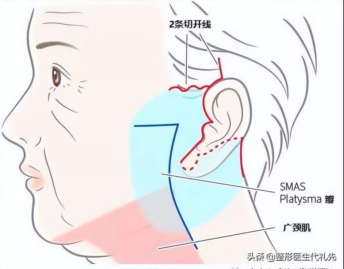 做过拉皮手术后，才知道下颌缘紧致是真的好显年轻、有气质