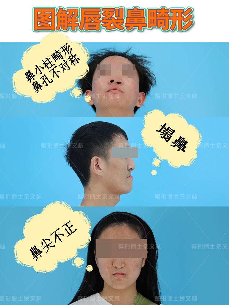 轻微兔唇会引起继发鼻畸形吗？唇裂鼻畸形要怎么修复？