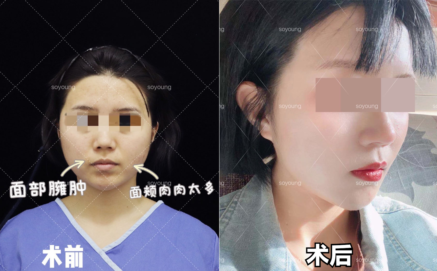 30岁的张女士面部吸脂，女儿读书回家以为我换了一张脸