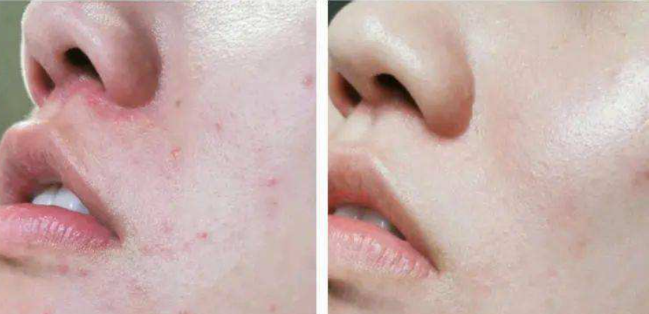 皮肤泛红怎么办?这"5种"极常见的皮肤泛红问题,解决办法在这 | aogbog