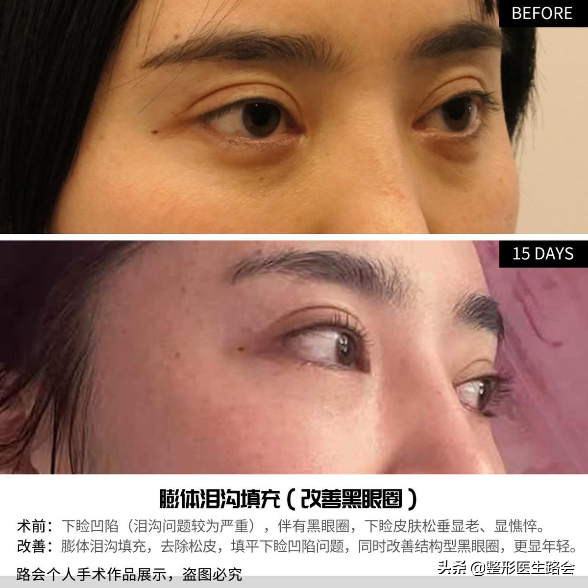 整形医生不会告诉你的：他会推荐亲人、朋友做脂肪填充泪沟吗？