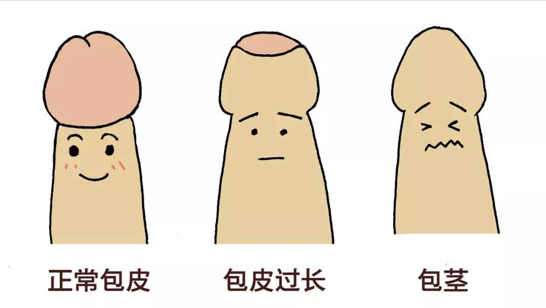 男孩99%包皮过长,到底要不要"割"?小儿泌尿医生这样说