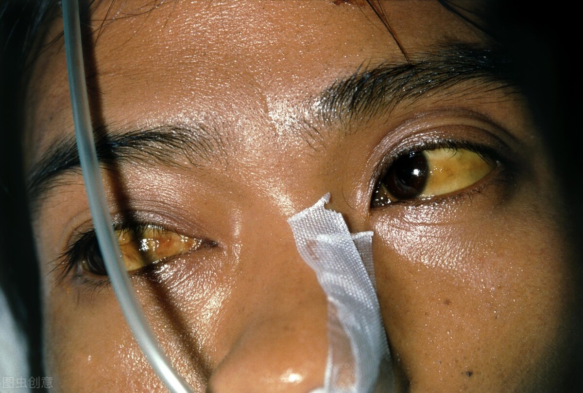 肝脏好不好，眼睛早知道？眼白出现这几种颜色，该注意了