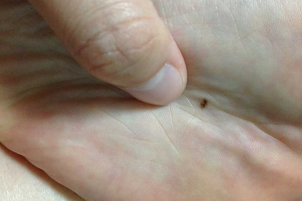 痣只会影响美观？当出现这些变化的时候要注意，可能会危害健康