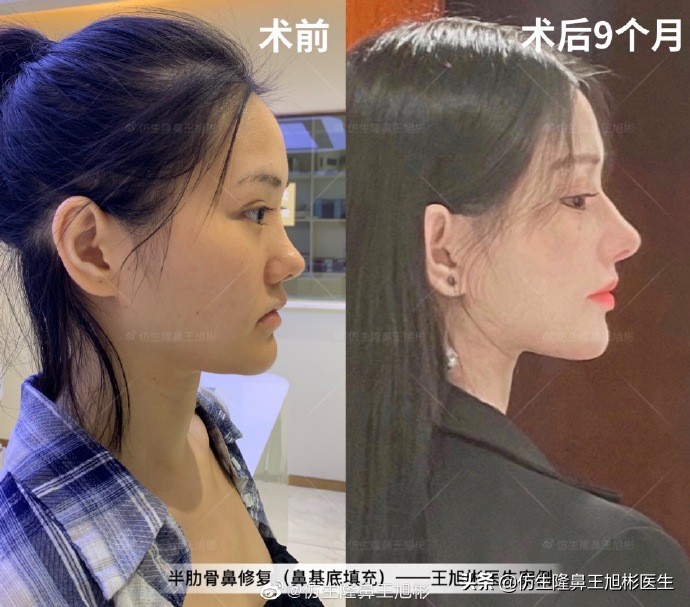 广州隆鼻科普：王旭彬鼻整形修复案例分享