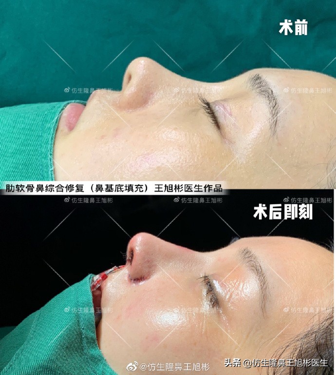 广州隆鼻科普：王旭彬鼻整形修复案例分享