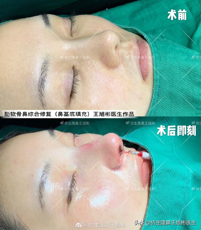 广州隆鼻科普：王旭彬鼻整形修复案例分享