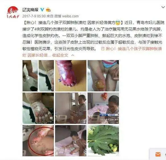 10个月女婴,被家人刮痧毁了脸