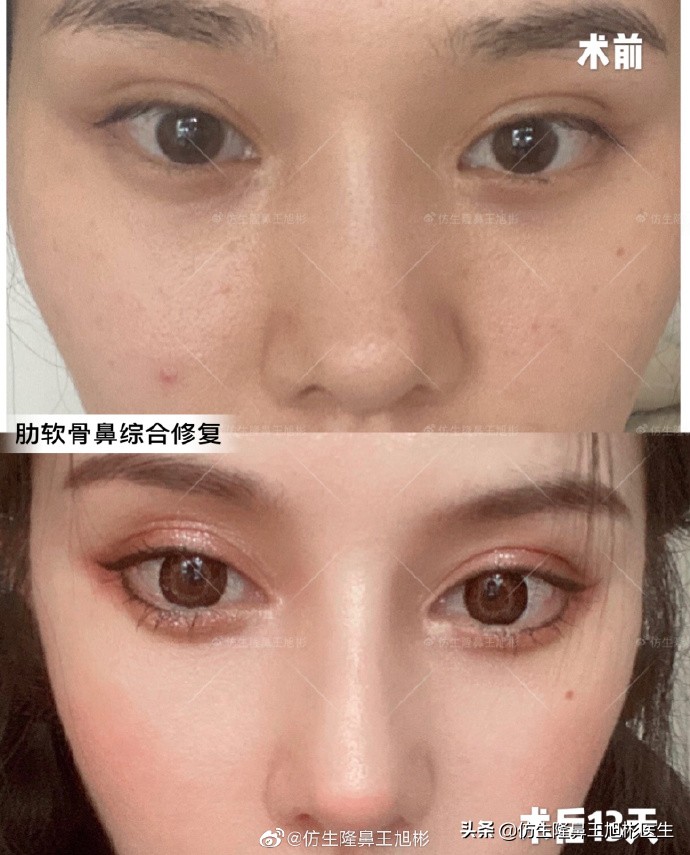 广州隆鼻科普：王旭彬鼻整形修复案例分享
