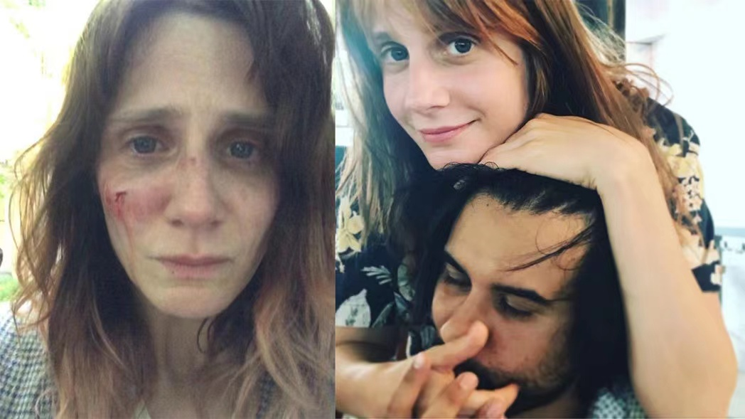 法国女星遭导演前男友家暴，社交平台曝光伤照，脸部青肿让人心疼