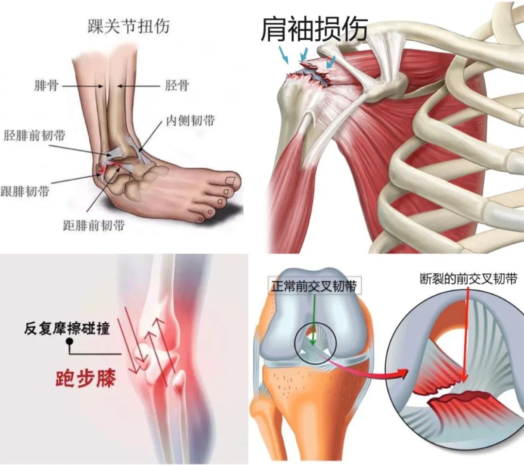 备战体育中考，运动损伤的孩子多了！医学运动科医生提醒这样做