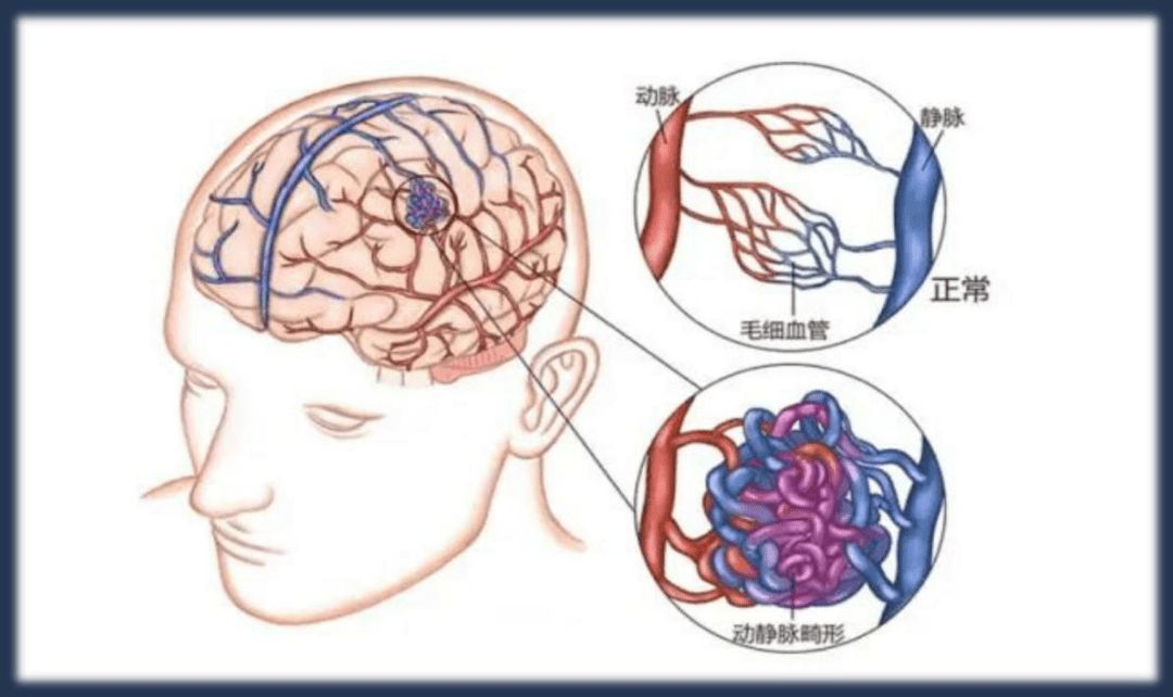 7岁孩童因脑血管畸形，险些丧命！孩子出现这6大症状，快检查