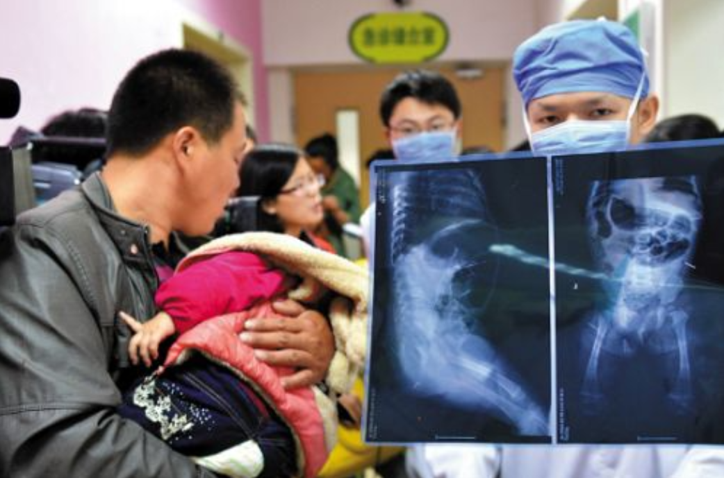 2014年，山东女婴体内“长”16根钢针，得知报警后舅妈服药自杀