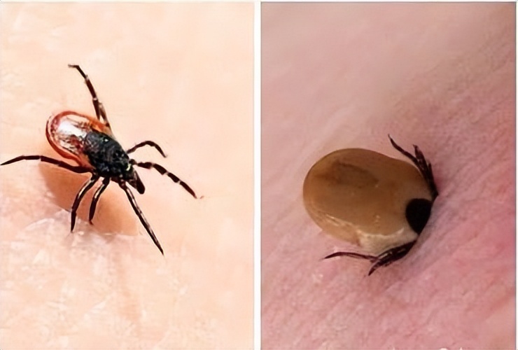 蜱虫夏季蜱虫病太可怕