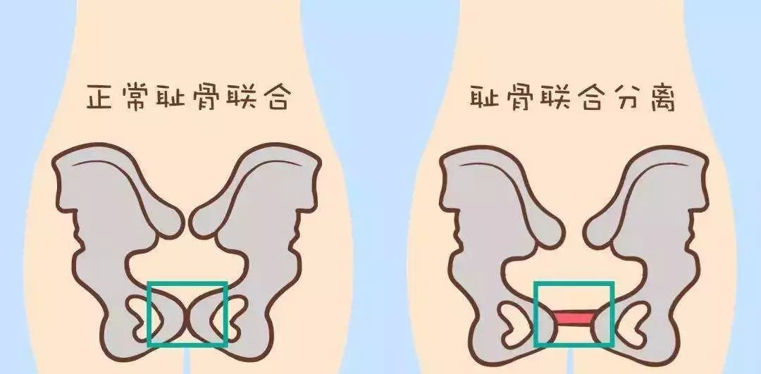 演员孙铱耻骨痛到无法走路，孕晚期的四大煎熬，怀过孕的深有体会