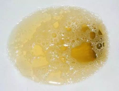 尿液出现2个异常变化,警惕是肾病来"敲门",及早发现还能救