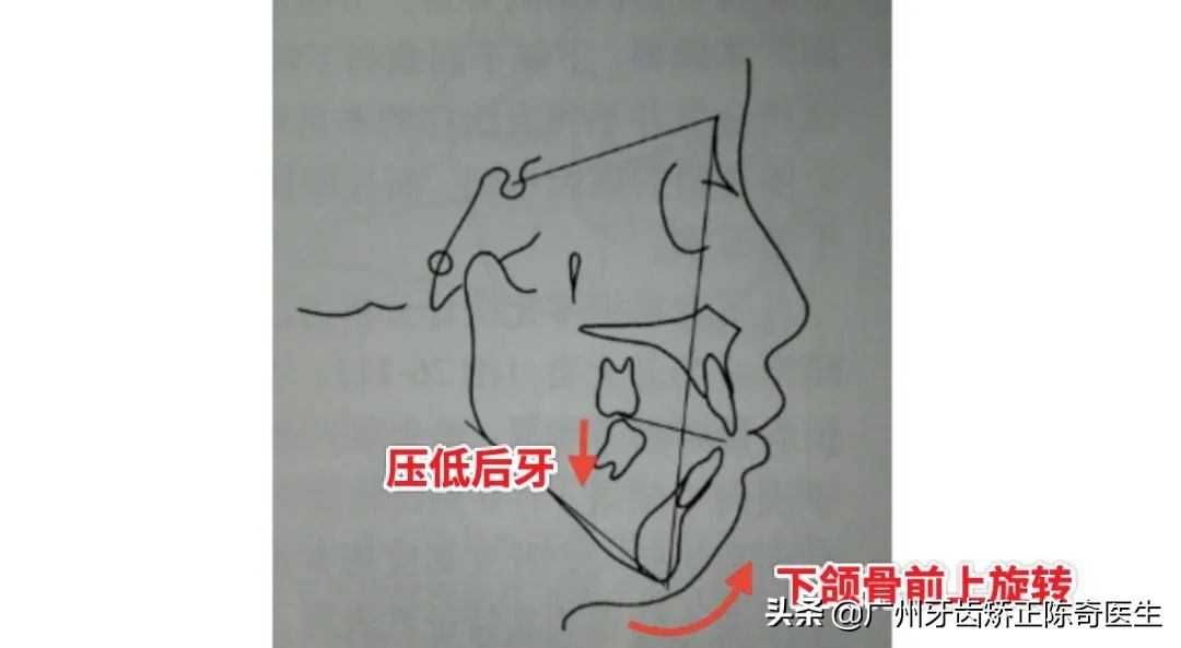 为什么有些人看起来没有下巴？如何科学的拥有下巴？