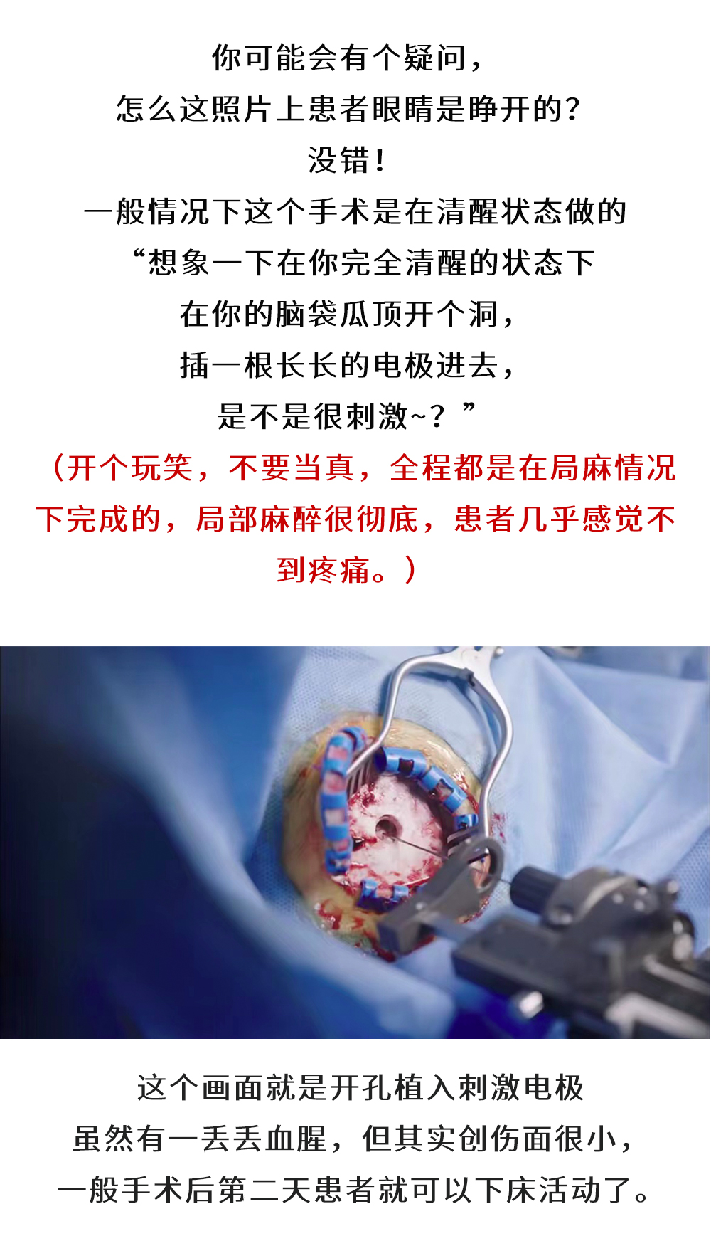 韩剧《Doctors》做起了脑起搏器手术，是天方夜谭还是有理有据？