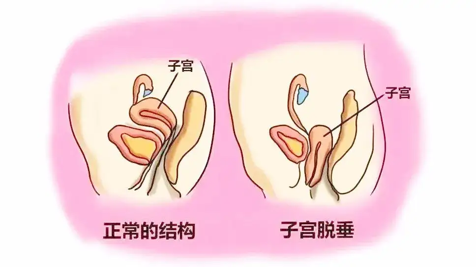 盆底是封閉骨盆下口的全部組織,通過其筋膜,肌肉,韌帶等組織承託盆腔