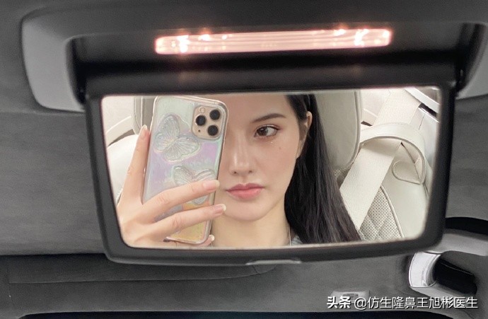 广州隆鼻科普：王旭彬鼻整形修复案例分享