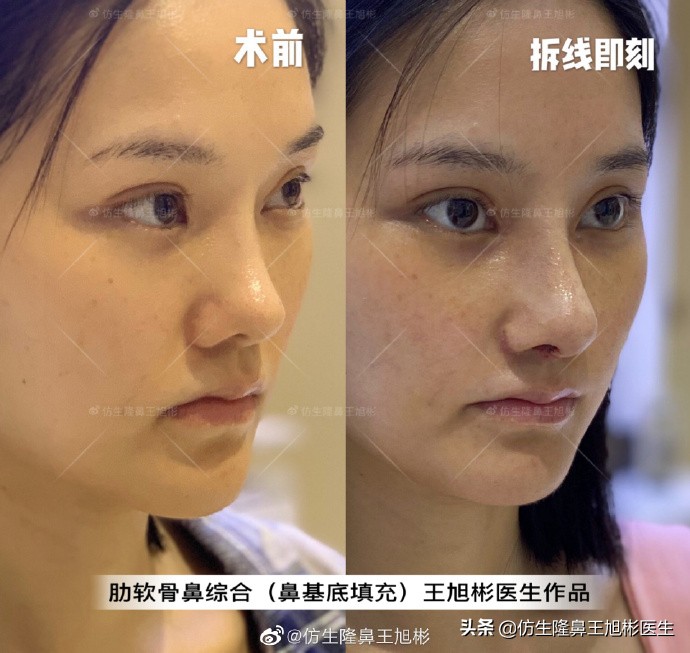 广州隆鼻科普：王旭彬鼻整形修复案例分享