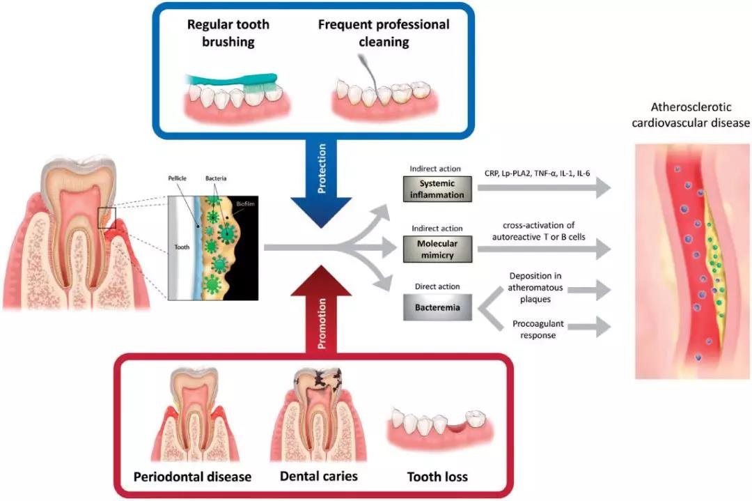 牙齿经常上火、牙龈发炎的人注意了！你们可能已被心血管疾病盯上
