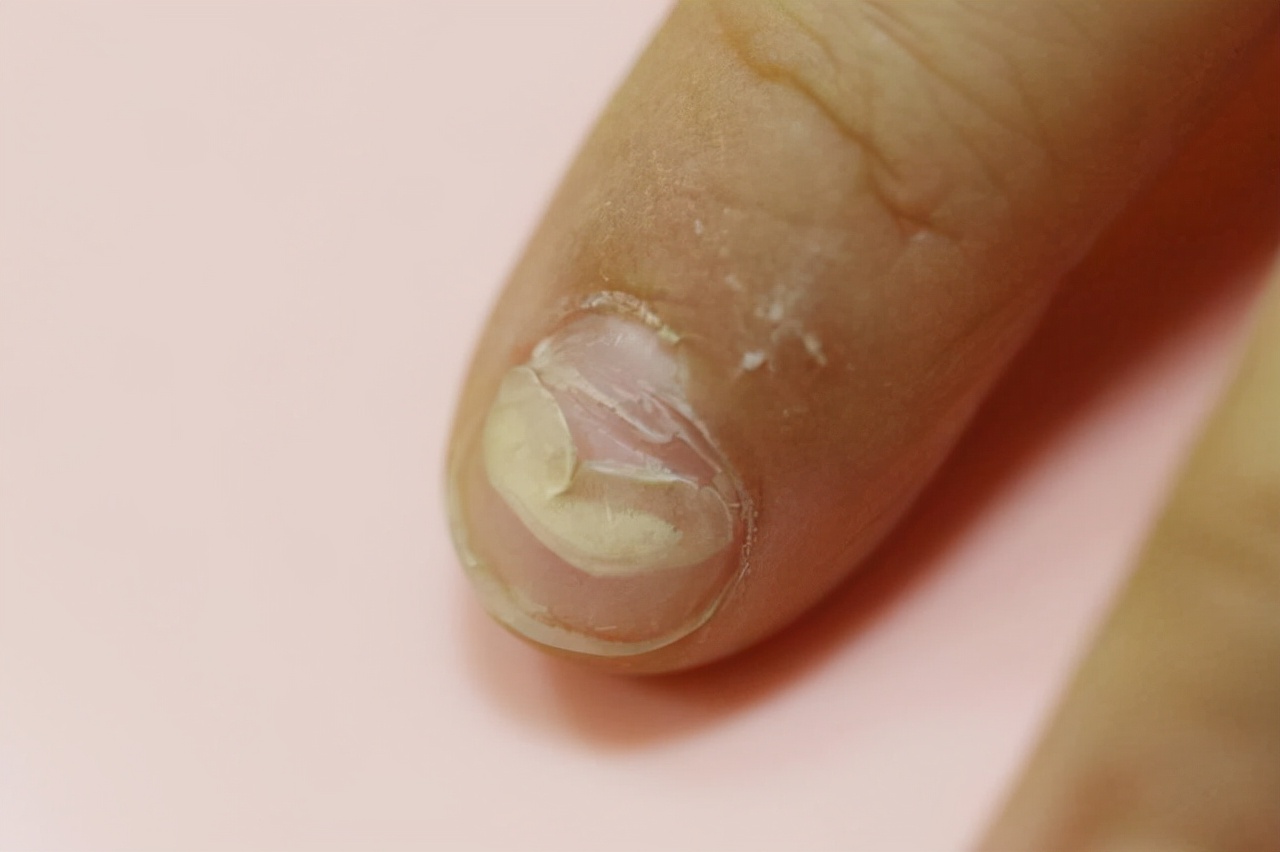 手指甲为什么会出现“竖纹”？指甲常出现的几个问题，建议了解下