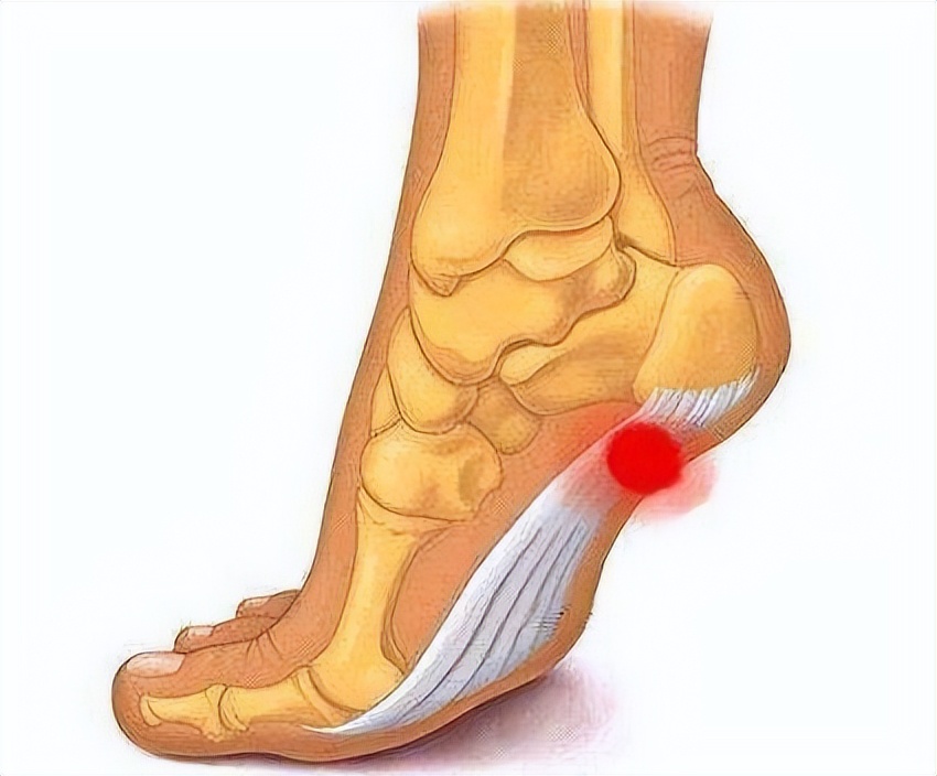 走路腳後跟疼，可能與哪種疾病有關？ 該怎樣預防？ 望知曉