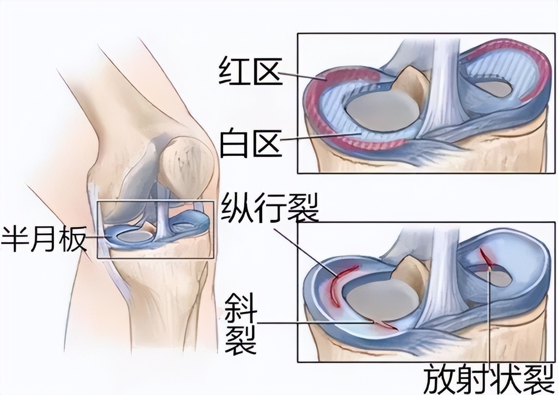 等老了再“養”膝蓋就晚了！ 提醒：保護膝關節，從這4種方法開始