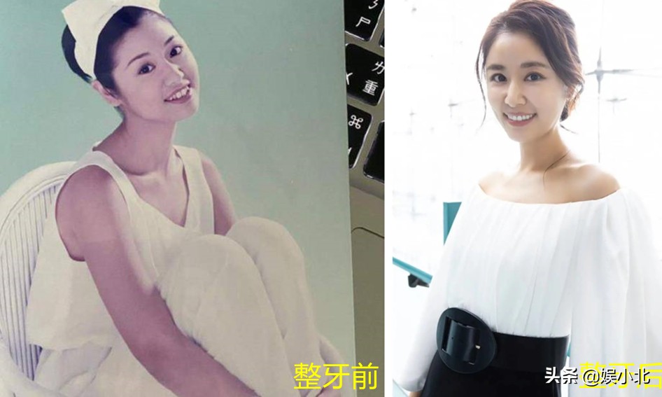 说刘亦菲牙齿丑的，是烤瓷牙看多了吧？