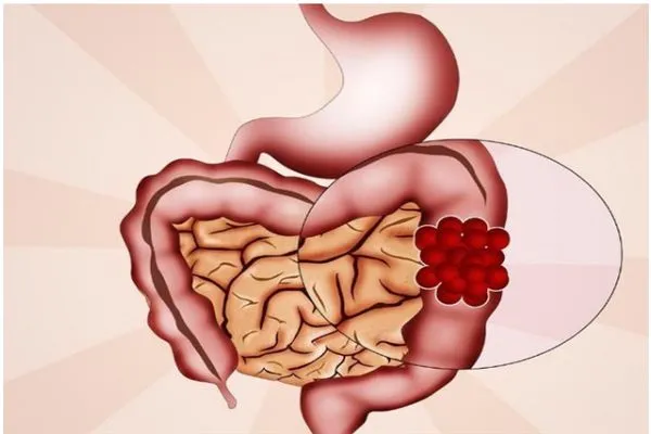 "新辅助治疗"保肛成,"微创加灌洗"吻合畅