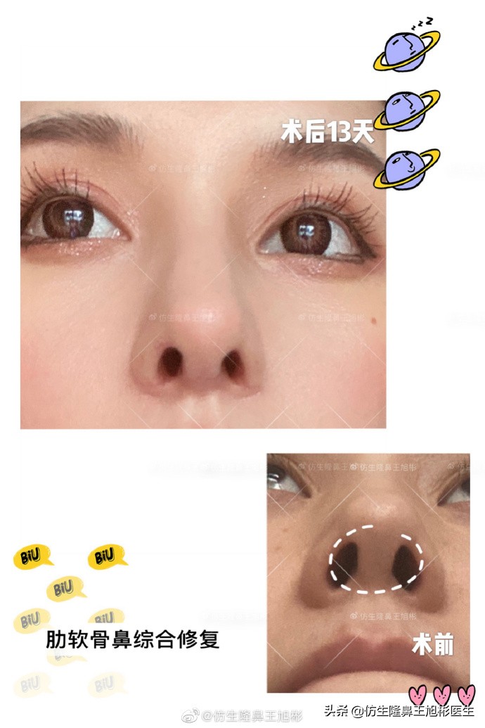 广州隆鼻科普：王旭彬鼻整形修复案例分享