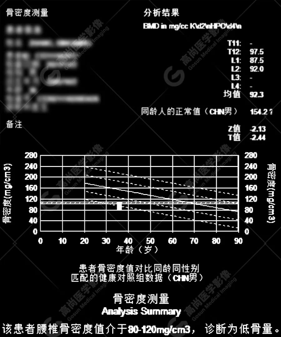 骨密度达到这个数，提醒你要补补钙了？专家为你解答