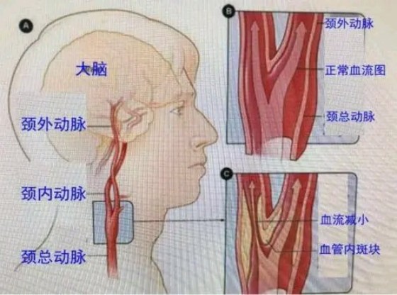 颈动脉做什么检查图片