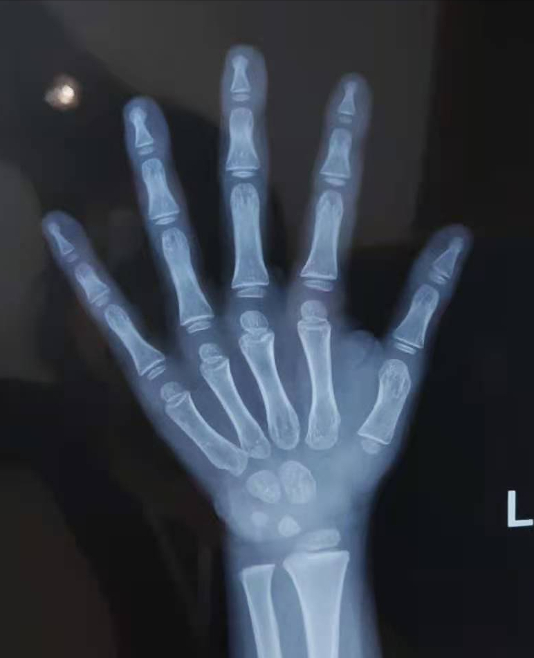 一般是拍摄左手x光片,在长期的研究中,发现手腕部含有多种类型的众多