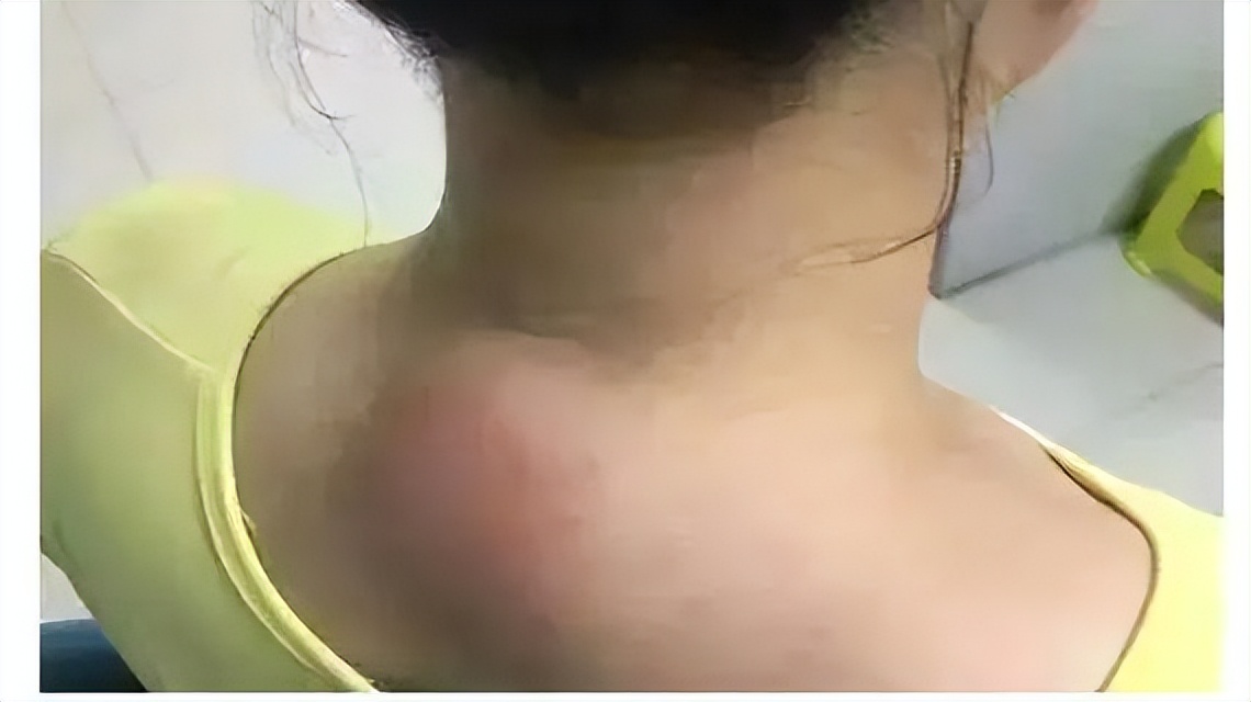 脖子后面的"富贵包",究竟是怎么长出来的?4招教你科学缓解