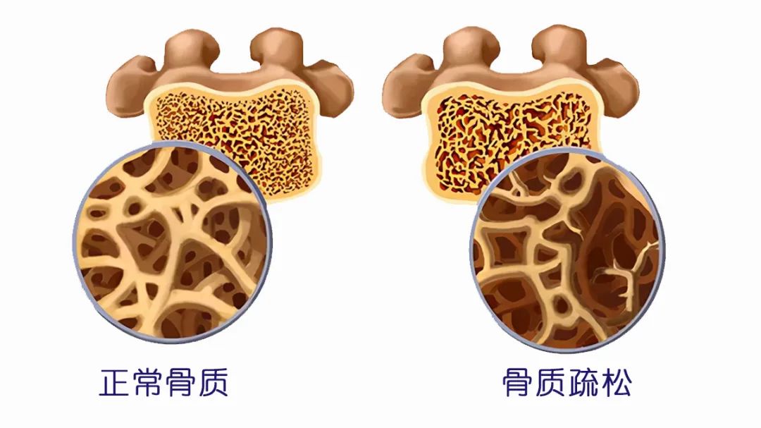 骨密度达到这个数，提醒你要补补钙了？专家为你解答