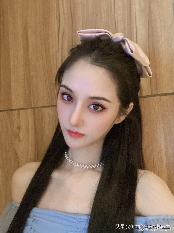 广州隆鼻科普：王旭彬鼻整形修复案例分享