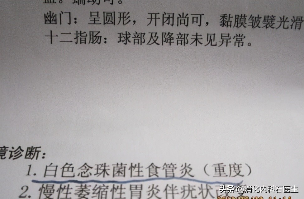 女子剧咳、胸痛治疗无效，胃镜一做，医生浑身鸡皮疙瘩直立